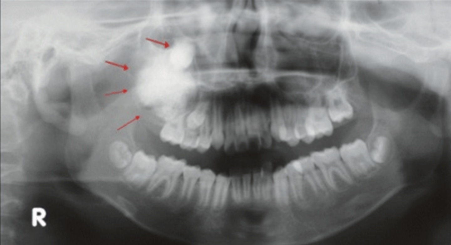 <p>xray- varying amount of radiopaque material- looks like displaced and unerupted teeth</p>
