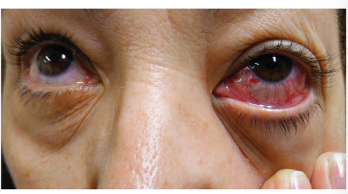 <ol><li><p>• Pulsations of the globe </p></li><li><p>• Irritated red eye</p></li><li><p> • Eyelid edema</p></li></ol><p></p>