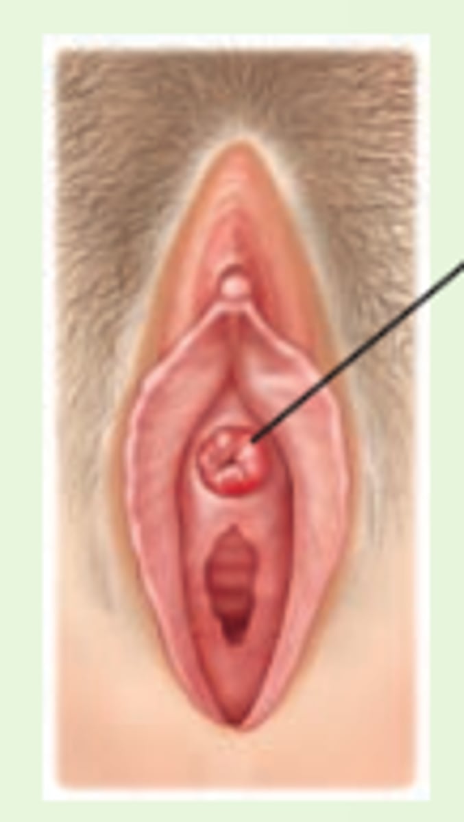 <p>swollen red ring around the urethral meatus</p>
