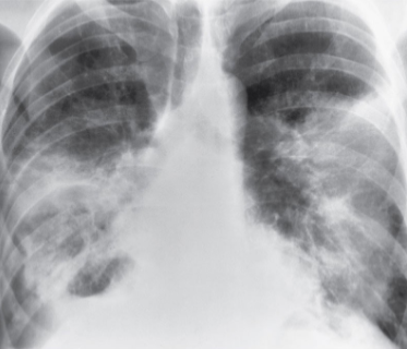 <p>Aspiration pneumonia</p>