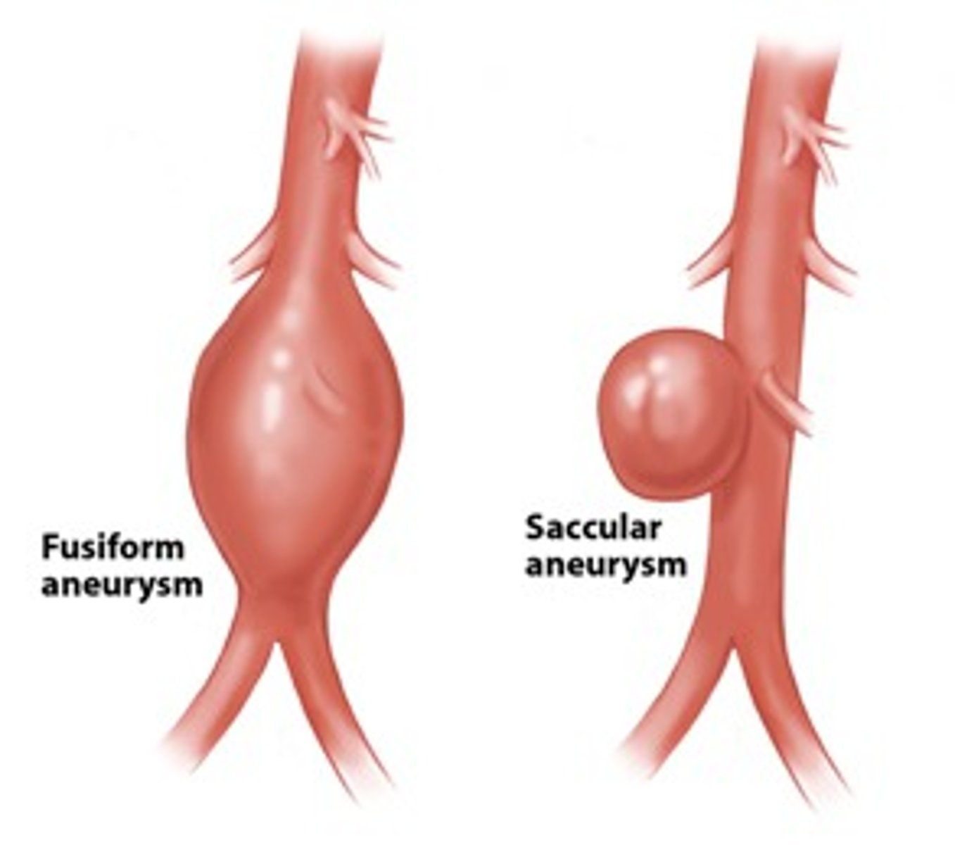 <p>Ballooning of a weakened portion of an arterial wall</p><p>-Note: An aneurysm is NOT mean a leaking vessel.</p><p>-Prone to bursting</p>