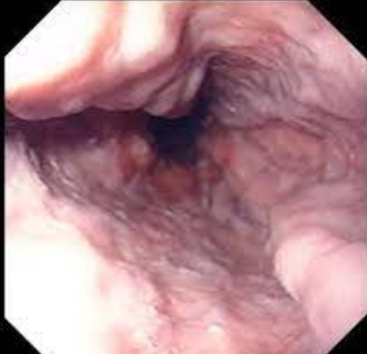 <p><span style="font-family: Droid Sans Mono, monospace">ESOPHAGEAL VARICES</span></p>