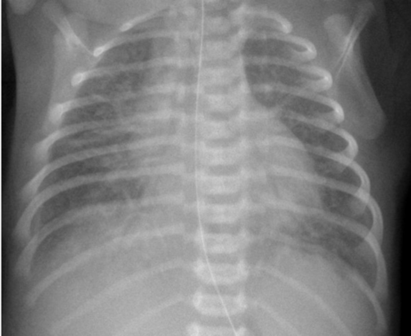 <p>during infants first breath amniotic(fecal waste) is inhaled and enters the lungs. Baby swallows meconium</p><p>smokey appearance on CT</p>