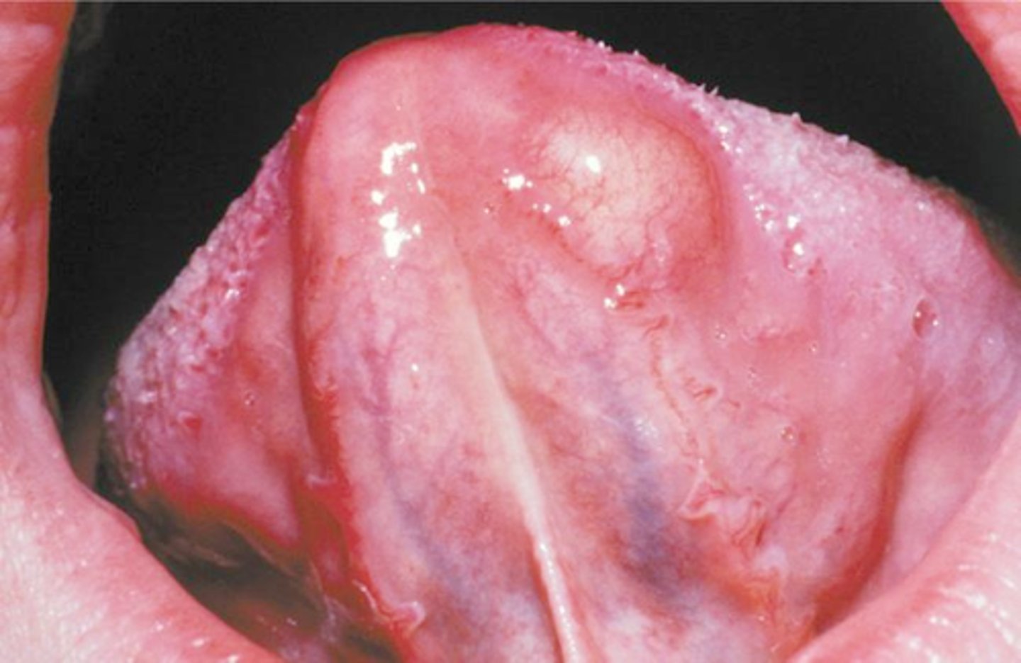 <p>• Slow-growing, soft, painless</p><p>lesions that vary in size from</p><p>small nodules to larger masses</p><p>• Can be in the soft tissue or</p><p>central (in bone)</p>