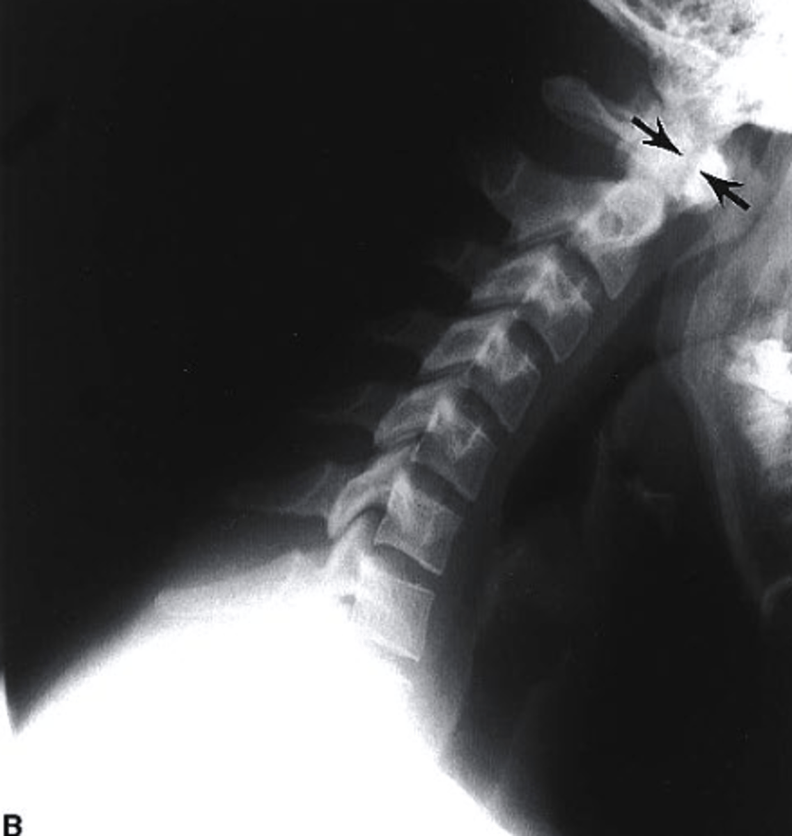 <p>what view is this?</p><p>a. extension stress</p><p>b. flexion stress</p><p>c. lateral</p><p>d. oblique</p>