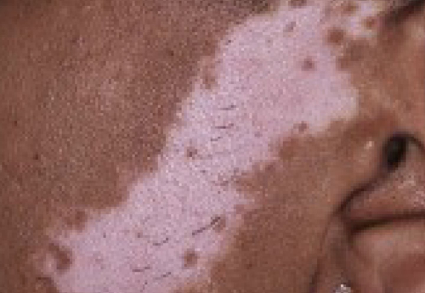 <p>A flat, non-palpable lesion &gt; 1.0 cm in size</p>