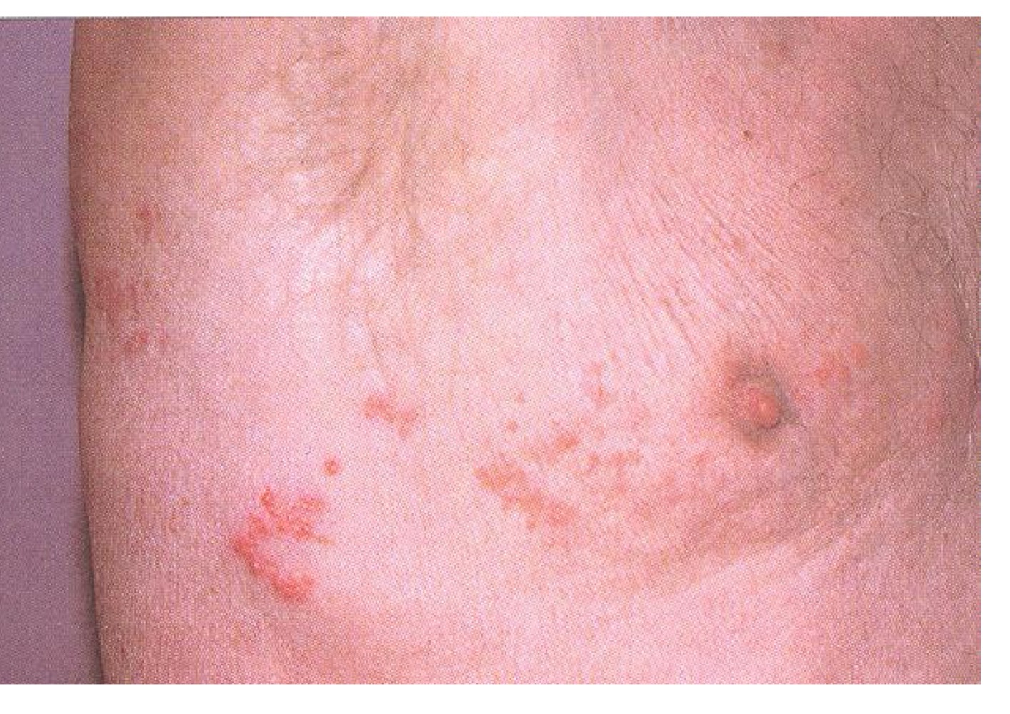 <p>what infection is this? </p>