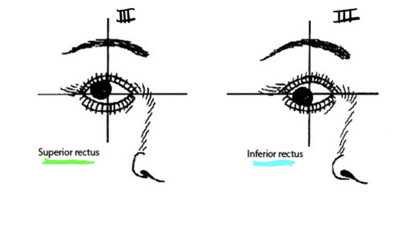 <p>the fact that the superior and inferior rectus muscles are attached posteriorly and medial to the position of the eyeball in the orbit</p>