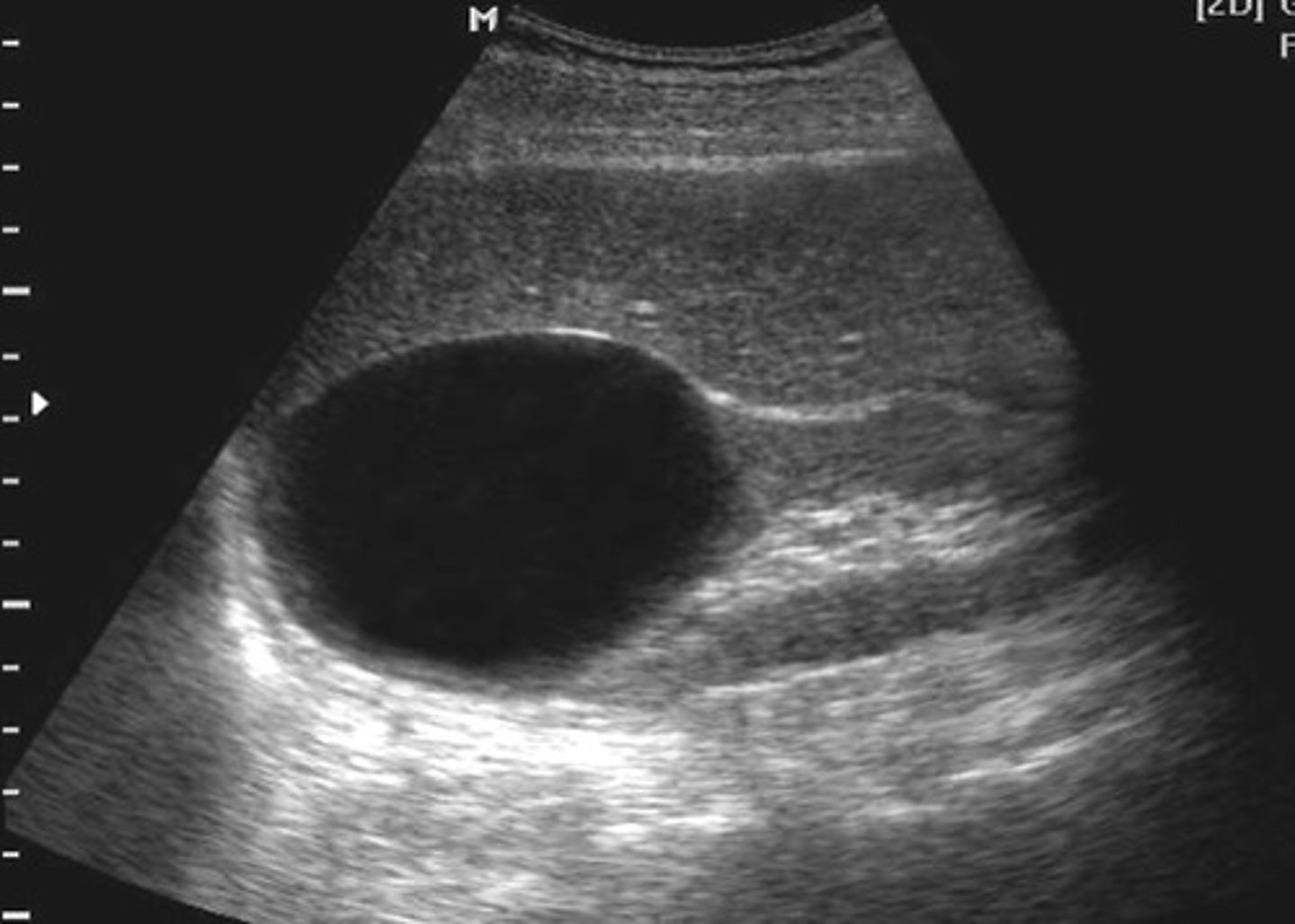 <p>With simple renal cysts, ___ is unknown</p>