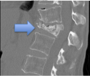 <p>What type of fracture is this?</p>
