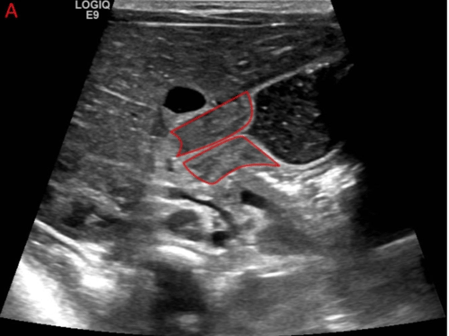 <p>1.) Ultrasound is most common test ordered.</p><p>UGI series will show string sign.</p><p>2.) Pyloric Stenosis</p><p>3.) Treatment</p><p>- Surgical</p><p>-Rehydration</p>