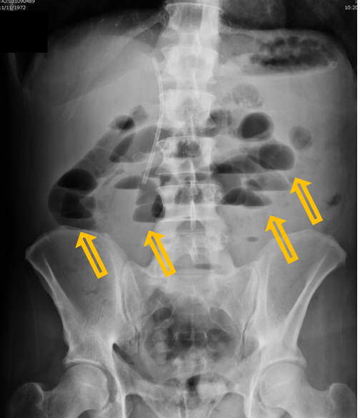 <p>Patient history: vomiting and acute abdominal pain, swelling in the groin region </p><p>Modality: abdominal radiograph, erect position </p><p>Region: abdomen and pelvis </p><p>Radiologic sign: Several, distended (2-3 cm in diameter), meteoristic small bowel loops in the upper abdomen containing air-fluid levels (yellow arrows). The colon contains less gas than normal. A stent is visible in the extrahepatic bile ducts. </p><p>Diagnosis: mechanical small bowel ileus caused by incarcerated inguinal hernia </p>