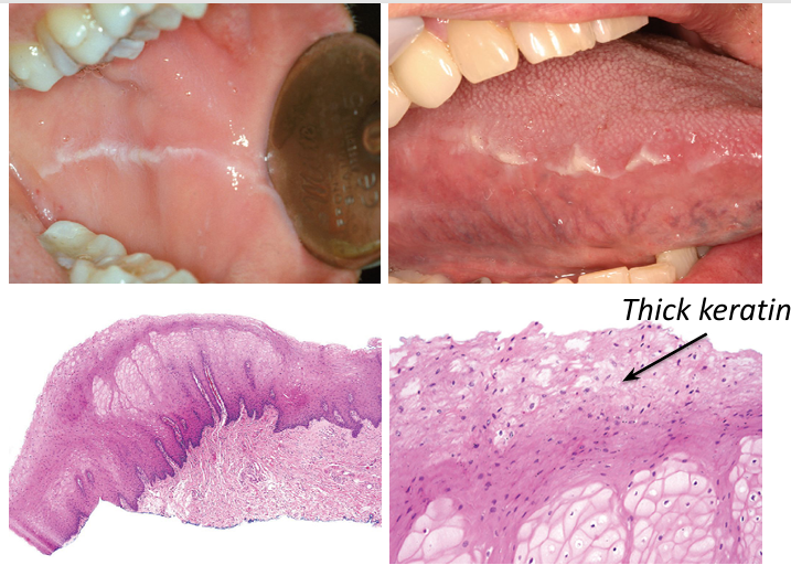 <p>-white line</p><p>-hyperkeratosis of buccal mucosa (usually) along occlusal plane, usually bilateral:</p><p>-common consequence of frictional irritation or sucking trauma (from facial surfaces of teeth)</p><p>-not caused by dental problems</p><p>-may be scalloped</p><p>-dentulous areas only</p><p>-often more pronounced near posterior teeth</p>