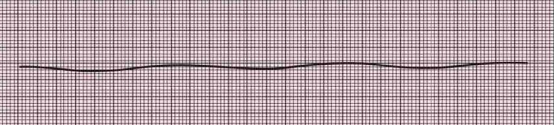 <p>EKG</p>