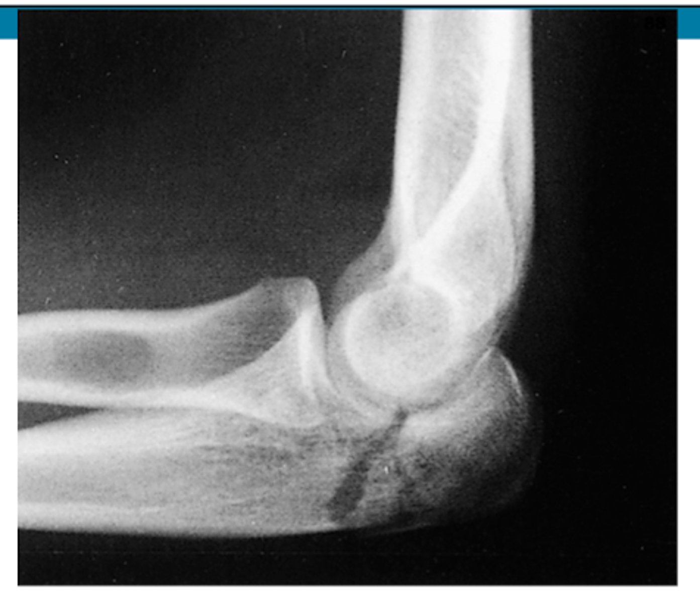 <p>olecranon fracture</p>