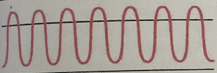 <ul><li><p><strong>Increased rate </strong>and <strong>depth</strong></p></li><li><p>Usually occurs with</p><ul><li><p>Extreme exercise</p></li><li><p>Fear</p></li><li><p>Anxiety</p></li><li><p>Disorders of CNS</p></li><li><p>Salicylate Overdose</p></li><li><p>Severe Anxiety</p></li></ul></li></ul><p></p>