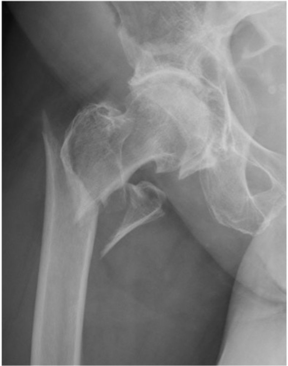 <p>bone is splintered or crushed, resulting in 2 or more fragments</p>