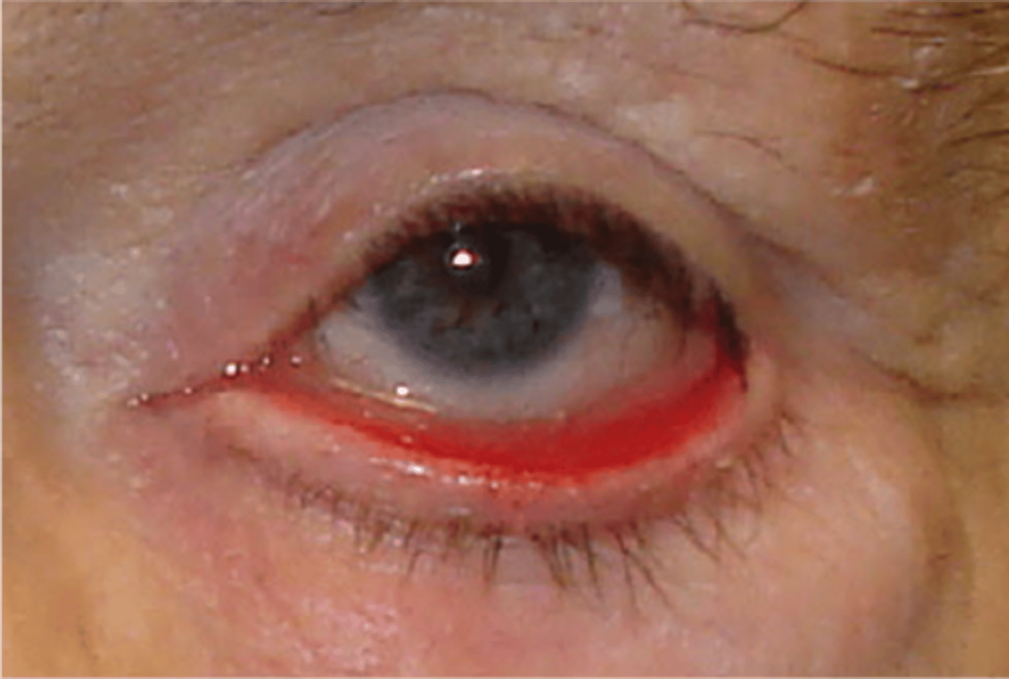 <p><u>Etio:</u>  muscle weakness, facial paralysis, scars, surgeries, eyelid growths, genetic</p><p><u>S&amp;S</u>: lower lid turns <strong><mark data-color="#daff00" style="background-color: #daff00; color: inherit">OUTward</mark></strong>, <strong><mark data-color="#cbfc00" style="background-color: #cbfc00; color: inherit">older adults</mark></strong>, <strong>lower eyelid is more commonly affected,</strong> <strong><mark data-color="#e5ef00" style="background-color: #e5ef00; color: inherit">excessive tearing</mark></strong>, dry eye, saggy eyelid</p><p><u>Complications</u>: Corneal irritation, dryness, abrasions, ulcers</p><p><u>Tx</u>: <strong><mark data-color="#f7fc00" style="background-color: #f7fc00; color: inherit">artificial tears, wear sunglasses,</mark></strong> avoid contacts, surgery, ophto referral</p>