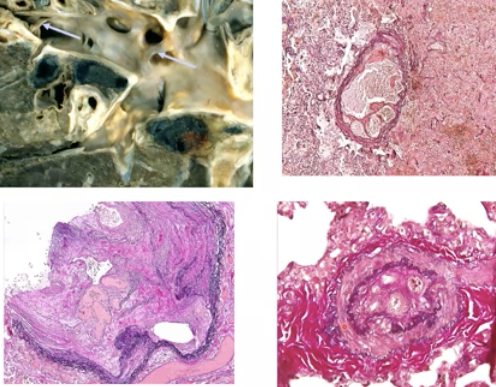 Lung infarction → Not enough supply of O2 to the lung tissue 

\
