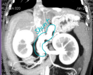 <p><span>Liver Shunts</span></p>