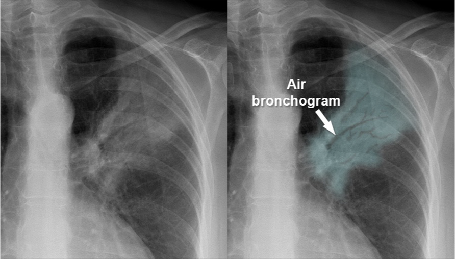 <p>Air bronchogram sign</p>