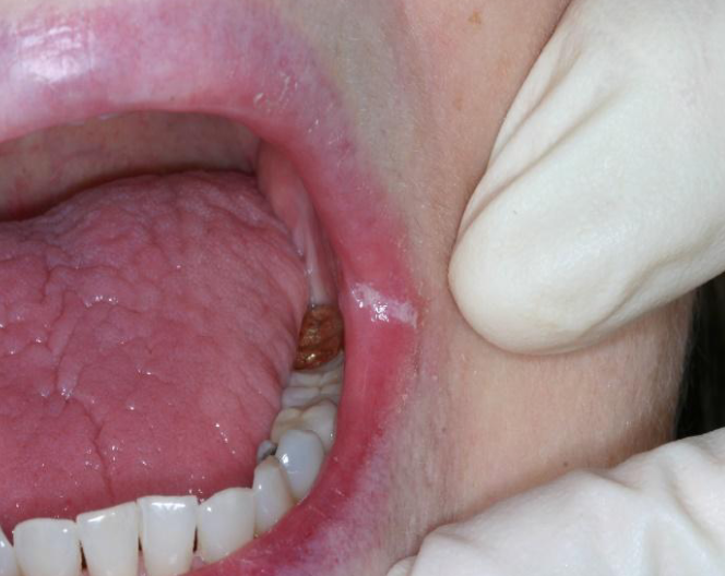 <p>candidiasis infecttion at angle of mouth that does not rub off </p>