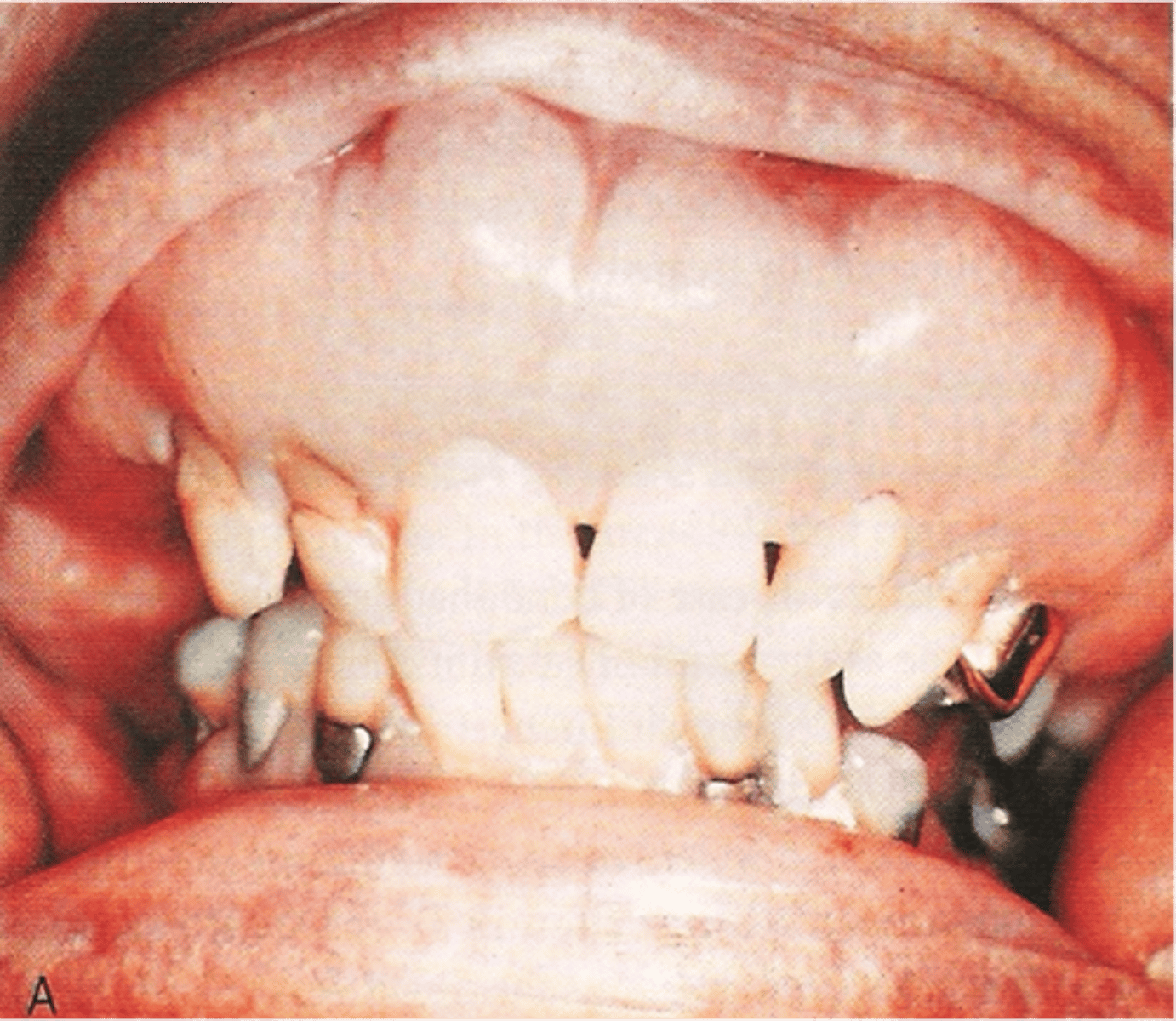 <p>chronic metabolic bone disease</p>