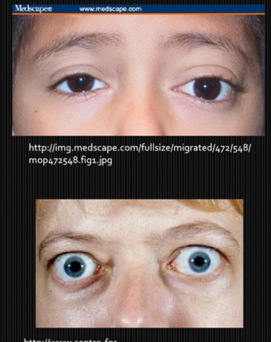 <p>child = orbital cellulitis, tumors</p><p>adult = TED</p>