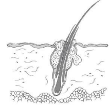 <p>Pústula que involucra un folículo piloso</p><p>Dermatodicosis, dermatofitosis, infecciones por Staphylococcus es lo común</p>