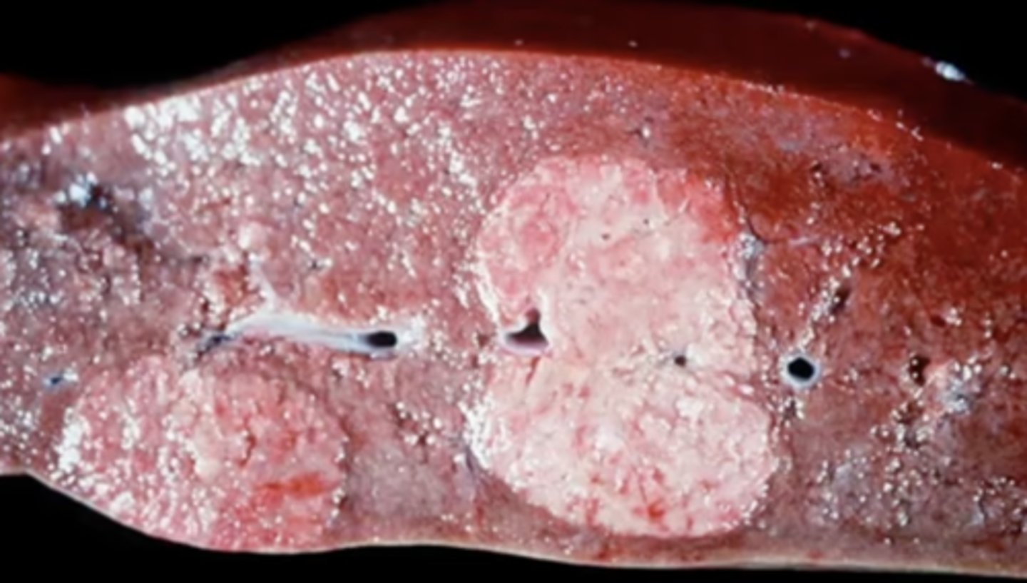 <p>What has caused this gross appearance of this liver?</p>