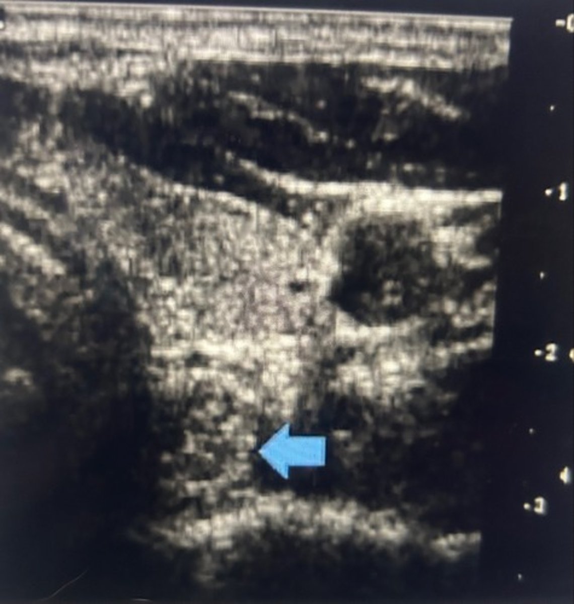 <p>Request that the patient swallow to better evaluate the area</p>