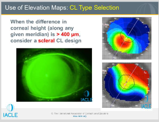 <p>Pt has PMD-kissing doves pattern</p><p>Difference map of the elevation of the eye presented in inferior pic measured in microns</p><p>Along the 1</p>