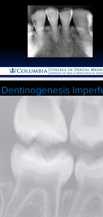 <p>-dentinogenesis imperfecta</p><p>-short chubby crowns with long slender roots</p><p>-cervical constriction</p><p>-pulp chambers can be complete radiopaque or completely radiolucent (wide spectrum of appearance)</p>