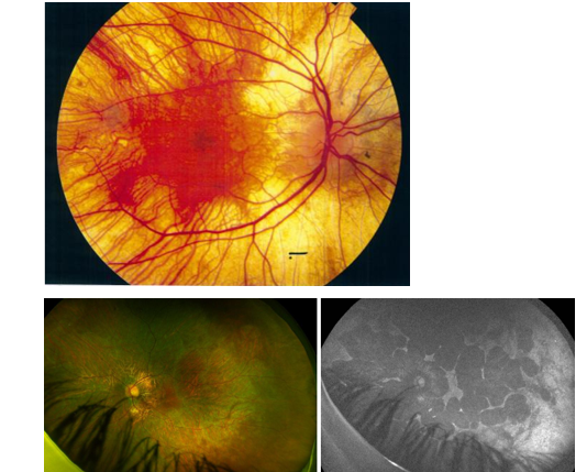 <ul><li><p>Here you are not just losing PRs and RPE, but also choroid, so you get a retina that looks very brought &amp; white bc you are looking at sclera —&gt; easily diagnosed</p></li><li><p>symptoms:&nbsp;<span><span>·</span></span><span style="font-family: &quot;Times New Roman&quot;; line-height: normal; font-size: 7pt;"><span>&nbsp;&nbsp;&nbsp;&nbsp;&nbsp;&nbsp;&nbsp;&nbsp; </span></span>Symptoms very similar to RP: Night vision problems, loss of peripheral vision, affects ppl at young age &lt;20, but unlike RP, fundus doesn’t have intraretinal pigmentation &amp; blood vessels are not attenuated</p></li><li><p>X-linked inheritance therefore affects men more&nbsp;</p></li></ul><p></p>