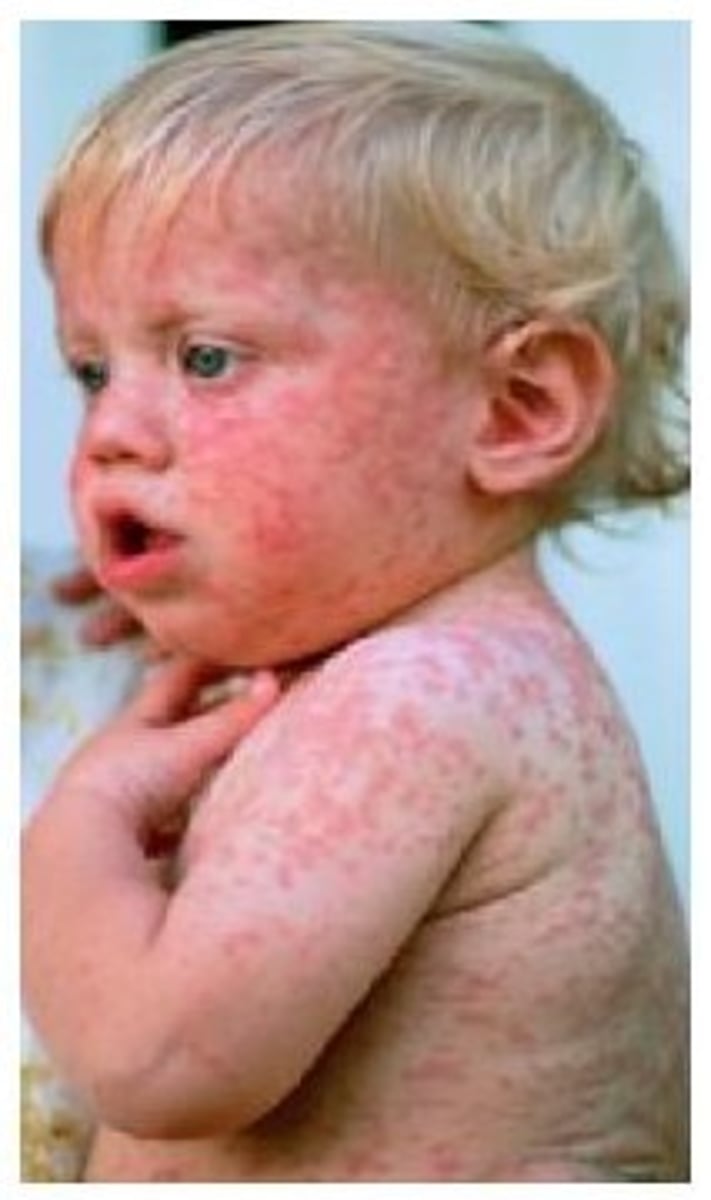 <p>Caused by the rubella virus, airborne, no treatment, MMR vaccine.</p>