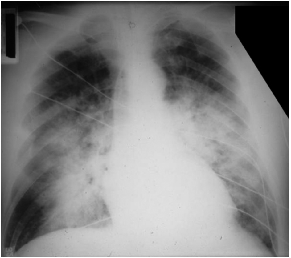 <p>Patient reports to the ER for SOB. He states that he almost drowned 5 days ago due to a boating accident. On a physical exam you note labored breathing, retractions, crackles, and rales. Vitals are stable with the exception of 144 bpm, 27 RR, and 89% on RA. CXR shows diffuse/patchy bilateral infiltrates in the dependent lung zones. What is your treatment plan?</p>