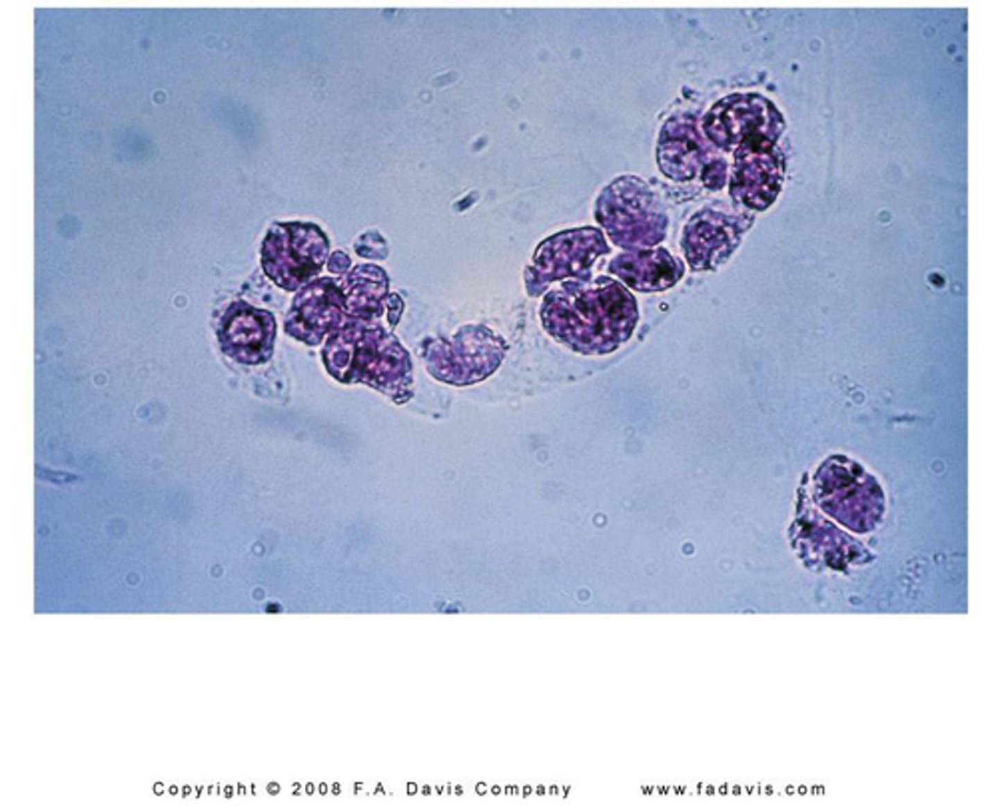 <p>Casts that contain RTE cells represent the presence of advanced tubular destruction, producing urinary stasis along with disruption of the tubular linings.</p><p>- Associated with heavy metal and chemical or drug-induced toxicity along with viral infections and allograft rejection.</p>
