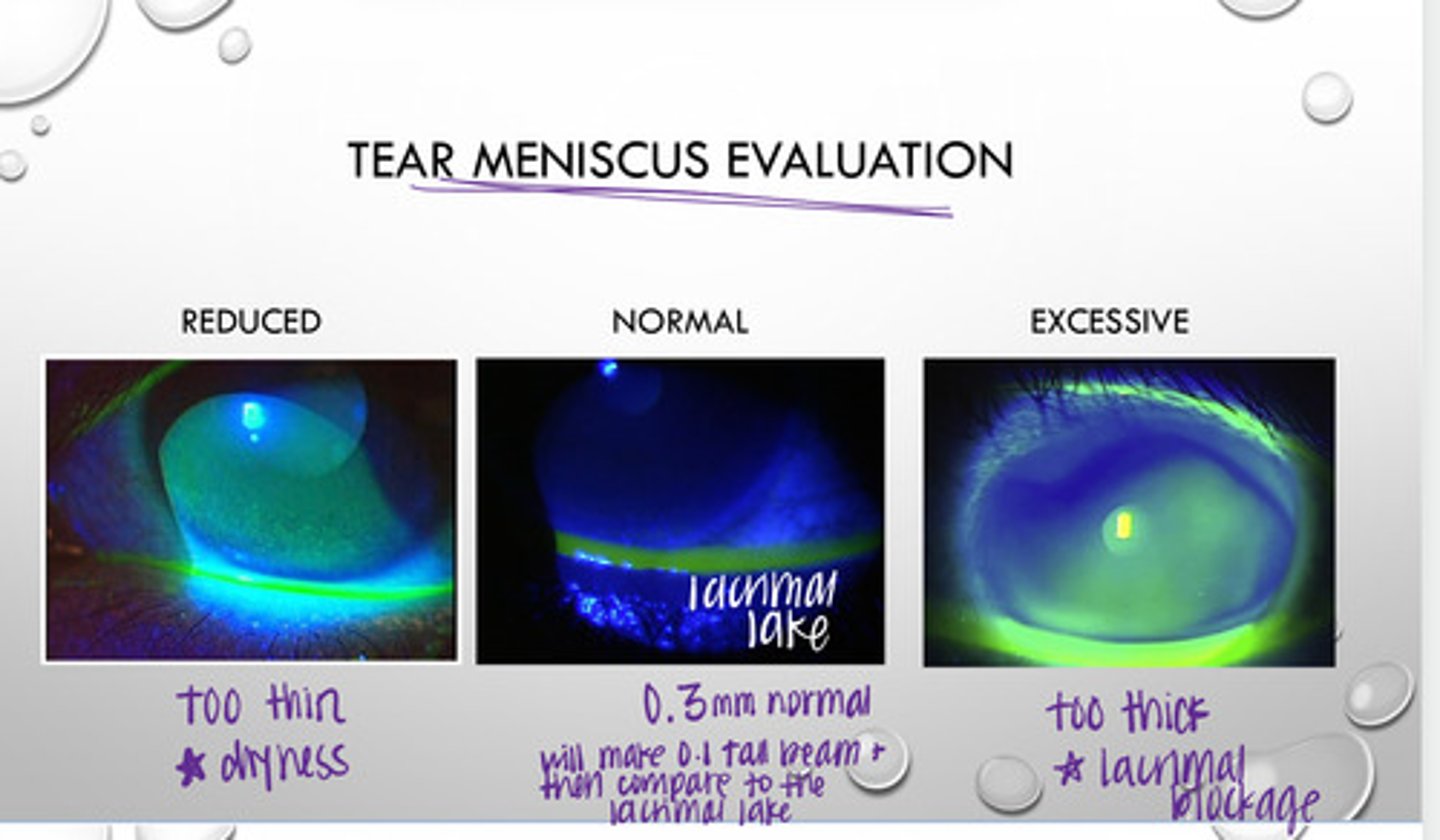 <p>What is an excessive value for the lacrimal lake in a tear meniscus evaluation? What could be the cause of this?</p>