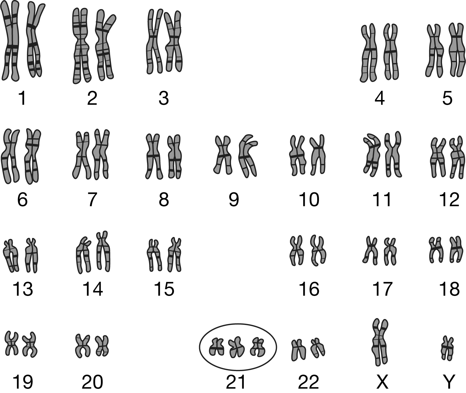 <p>Figure 1. A karyotype obtained from a sample of human cells——A karyotype is a representation of all the metaphase chromosomes in a sample of cells from a particular individual (Figure 1).——Which of the following most likely explains how the chromosomes circled in Figure 1 could cause a genetic disorder in the person from whom the cells were obtained?</p><p>A) The extra chromosome causes crowding in the nucleus of the cells and blocks R N A polymerase from binding to and transcribing certain genes.</p><p>B) The extra chromosome will affect the levels of <span>RNA</span> transcribed from certain genes and the amount of protein produced from those genes in each cell.</p><p>C) The cells will not divide and enable growth, because the extra chromosome will interfere with the pairing of homologous chromosomes.</p><p>D) The extra chromosome will cause other chromosomes in the cell to become triploid during future rounds of cell division.</p>