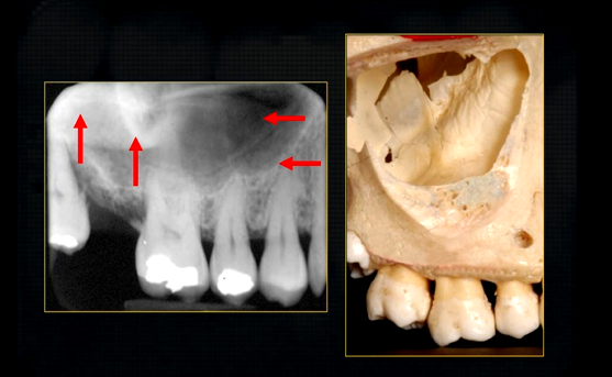 <p>radiolucent maxillary sinus and radiopaque floor</p><p>radiopaque shadow cast by zygoma, hollowed out by maxillary sinus </p>