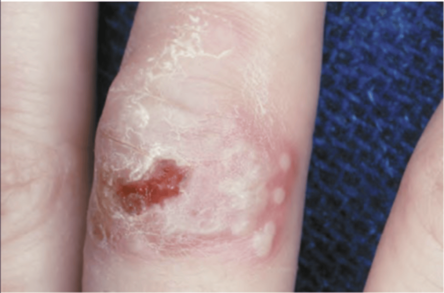 <p>Hint: Primary or recurrent infection of the fingers</p>