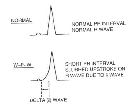 <p>Wolff-Parkinson-white (WPW)</p>