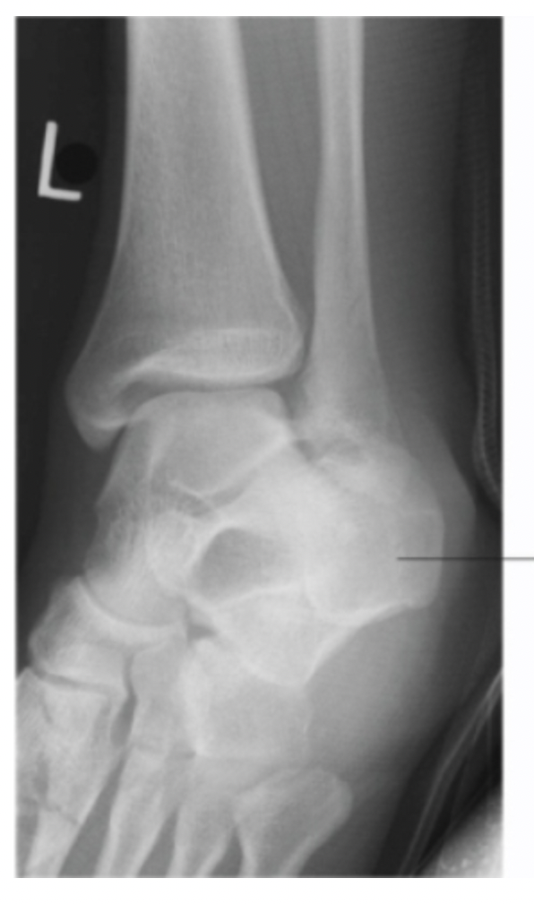 <p>This 45 degree oblique ankle image demonstrates the calcaneus obscuring the distal aspect of the lateral mortise and distal fibula. How should the radiographer correct this image?</p><p>a. <span>Increase internal rotation</span></p><p>b. <span>No correction needed</span></p><p>c. <span>Depress distal tibia</span></p><p>d. <span>Dorsiflex foot</span></p>