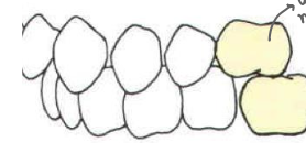 <p>Type of occlusion</p>