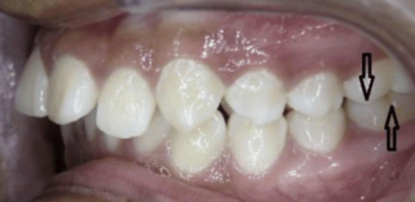 <p>Class II division 1</p>