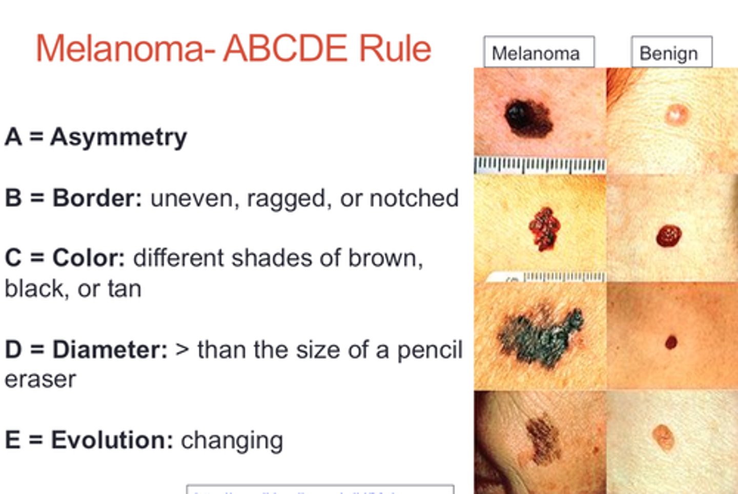 <p>used for recognizing melanoma: asymmetry, border irregularity, color, diameter, evolution</p>