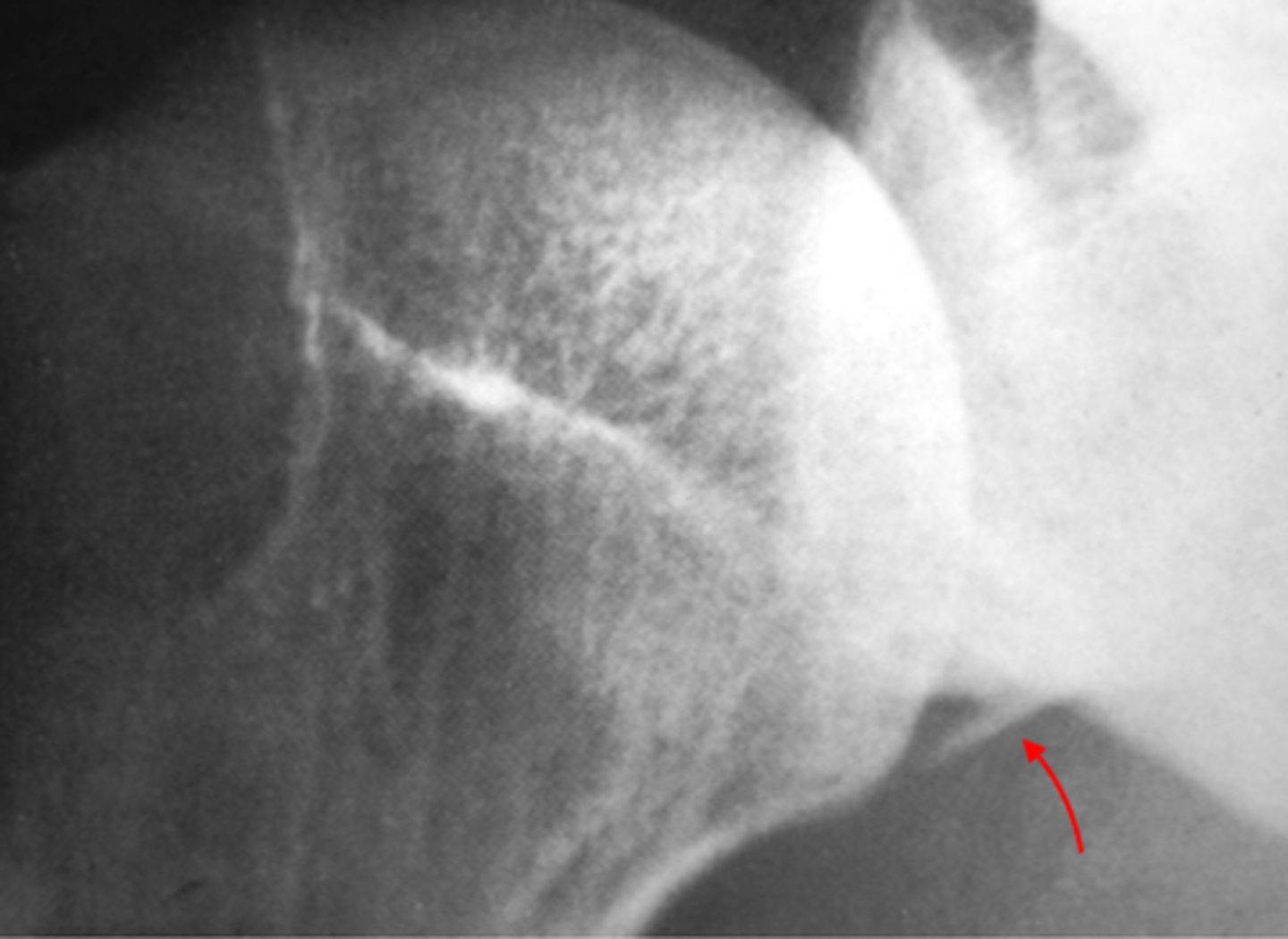 <p>tear of the labrum due to anterior dislocation or subluxation of the GH joint</p><p>anterior-inferior location</p>