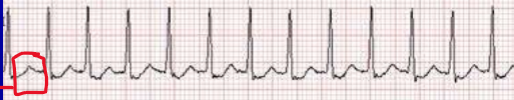 <p>What is the most likely rhythm in the following ECG trace?</p>