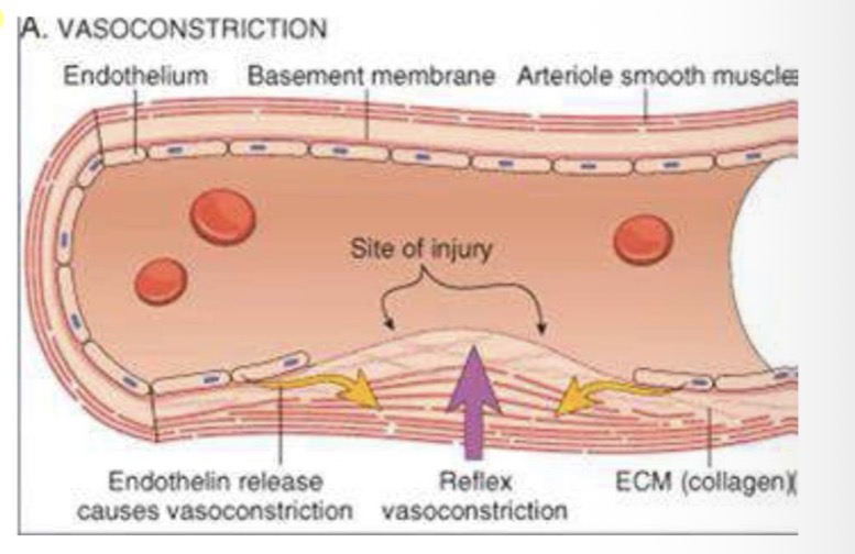 <p>• <strong>Inizio:</strong> Causato da danno del vaso (emodinamico, biologico, autoimmune).</p><p>• <strong>Bersaglio:</strong> Cellule endoteliali. La vasocostrizione o la perdita di endotelio espone il <strong>tessuto sottoendoteliale</strong> (collagene), innescando il processo.</p><p>Dopo il danno vascolare (o l'attivazione inappropriata), il sistema emostatico si attiva seguendo tappe precise che coinvolgono piastrine e coagulazione.</p><p><strong>1. Attivazione delle Piastrine</strong></p><p>Le piastrine aderiscono alla zona dove le cellule endoteliali sono scomparse.</p><p>• <strong>Adesione:</strong> Necessita di recettori specifici per legarsi a <strong>fattore di von Willebrand</strong> (prodotto dall'endotelio), <strong>collageno</strong> e <strong>fibrinogeno</strong>.</p><p>• <strong>Cambiamento di forma e Aggregazione:</strong> Le piastrine cambiano forma e si aggregano tra loro con l'aiuto del fibrinogeno.</p><p>• <strong>Rilascio di Fattori:</strong> Rilasciano <strong>ADP</strong> e <strong>trombossano</strong> per richiamare altre piastrine e potenziare l'aggregazione (feedback positivo). Nota: In condizioni normali, l'endotelio produce ADPasi per distruggere l'ADP e impedire l'aggregazione.</p><p>• <strong>Stabilizzazione:</strong> Le piastrine formano "spine" tra loro e l'aggregato diventa sempre più stabile.</p><p><strong>Ruolo del Fibrinogeno:</strong></p><p>Funge da "colla" o sostegno. Le piastrine esprimono recettori che lo riconoscono.</p><p>• Analogia con la VES: Come nell'infiammazione il fibrinogeno fa impilare i globuli rossi riducendo le cariche negative, qui permette l'aggregazione piastrinica.</p><p>• Il fibrinogeno è anche un fattore della coagulazione, creando un legame stretto tra componente piastrinica e cascata coagulativa.</p><p><strong>2. Attivazione della Coagulazione</strong></p><p>Le piastrine attivate offrono una superficie fosfolipidica per l'attivazione dei fattori.</p><p>• <strong>Shift Endoteliale:</strong> Le cellule endoteliali vicine al danno non vanno in necrosi ma cambiano funzione: da anti-emostasi passano a <strong>pro-emostasi</strong>, producendo il <strong>Fattore Tissutale</strong>.</p><p>Il <strong>Fattore Tissutale</strong> (pro-coagulante) è il primo elemento della <strong>via estrinseca</strong>, fondamentale per lo "start" della coagulazione.</p><p>• <strong>Formazione del Tappo:</strong> Si ha attivazione di <strong>Protrombina -> Trombina -> Fibrina</strong>. La fibrina forma una rete che stabilizza il tappo emostatico primario (inizialmente instabile) impedendo che venga portato via dal flusso.</p><p>• <strong>Doppia Velocità (Iniziazione e Amplificazione):</strong> La via estrinseca porta velocemente alla formazione di <strong>Trombina</strong>.</p><p>• La Trombina trasforma il fibrinogeno in fibrina.</p><p>• Attiva i fattori di accelerazione (<strong>V</strong> e <strong>VIII</strong>).</p><p>• <strong>Amplificazione (Via Intrinseca):</strong> L'attivazione innesca anche il <strong>Fattore IX</strong> (via intrinseca), che amplifica ulteriormente il sistema portando a una massiccia produzione di fibrina tramite l'attivazione del Fattore X.</p><p>• <strong>Fattori Vitamina K dipendenti:</strong> Importanti per la terapia e comprensione delle emorragie. Sono i fattori <strong>II, VII, IX e X</strong>.</p><p><strong>Crescita del Trombo:</strong></p><p>Il trombo cresce rapidamente all'interno del lume. Non è costituito solo da elementi emostatici, ma intrappola <strong>neutrofili</strong> e <strong>globuli rossi</strong> nella massa fibrinica.</p><p>• Conseguenza: La riduzione del lume riduce il flusso. Se il tessuto a valle richiede molto sangue (es. Cuore, SN), questa variazione diventa patologica e porta a morte tissutale.</p>