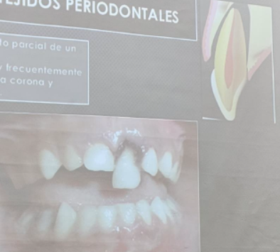 <ul><li><p><span>desplazamiento parcial de un diente en su alveolo</span></p><ul><li><p><span>Clínicamente se ven elongados y frecuentemente con una desviación palatina de la corona y suspendido por la encía palatina</span></p></li></ul></li></ul><p></p>